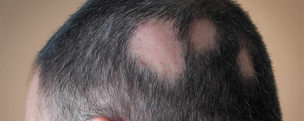 alopecia-izpadanje-las